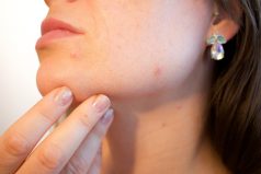 5 Possible Reasons Why Your Acne Creams Aren't Working